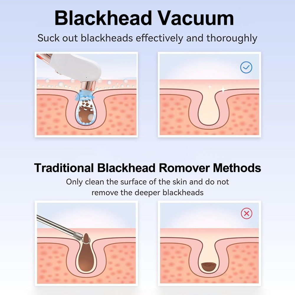Aspirateur électrique pour poi - Blackhead Remover Vacuum Suction avis et prix