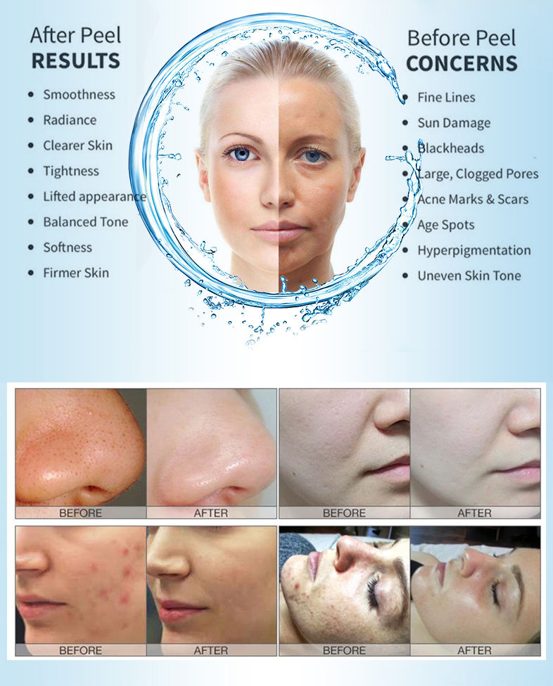 Appareil Hydra 4 en 1 pour pee - Hydra Dermabrasion Aqua Peel Machine avis et prix