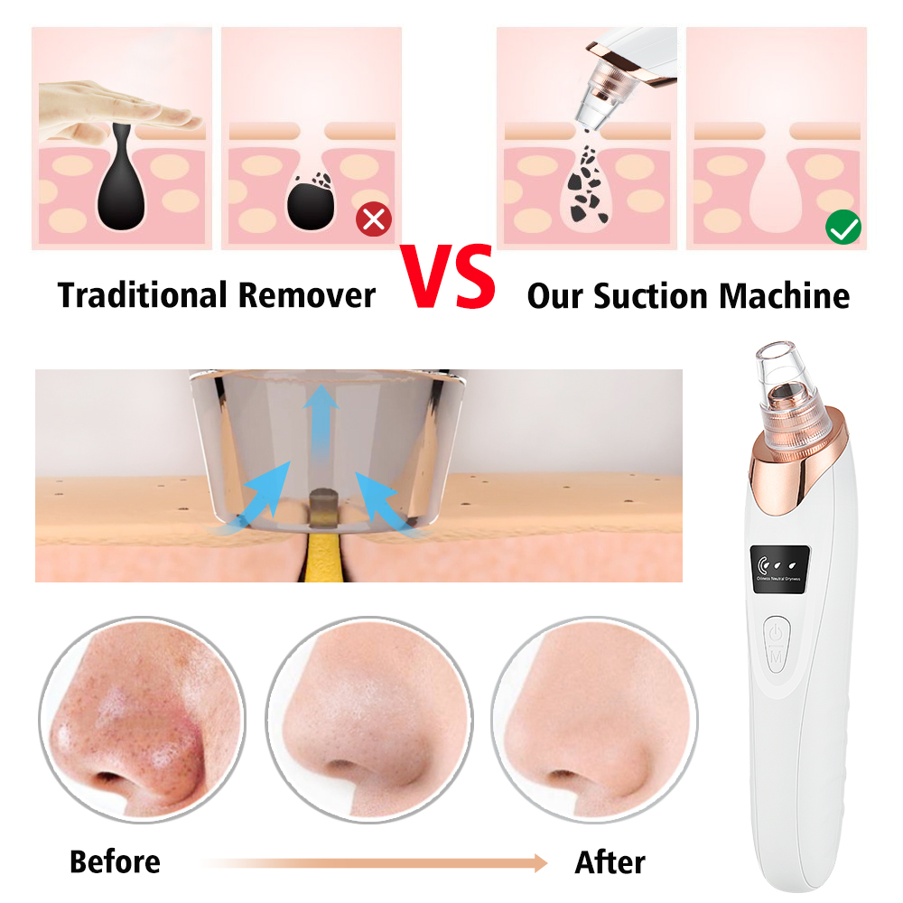 Aspirateur de points noirs, ne - Blackhead Remover Vacuum Suction avis et prix